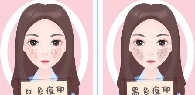 臉上紅色痘印幾個月都不消怎么辦？紅色痘印應該怎么消除？
